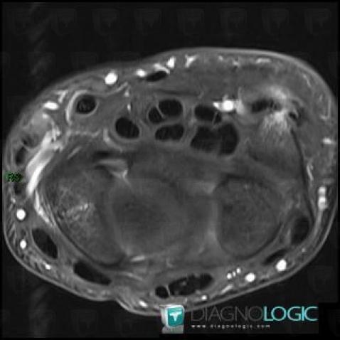 Tendinopathy - Tenosynovitis Wrist - Hand / Flexor carpi ulnaris, Tendons/palmar side - Wrist, MRI