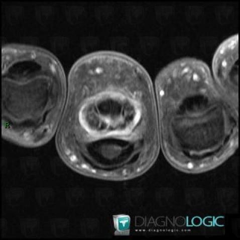 Tendinopathy - Tenosynovitis Wrist - Hand / Flexor digitorum, Tendons/palmar side - Hand, MRI