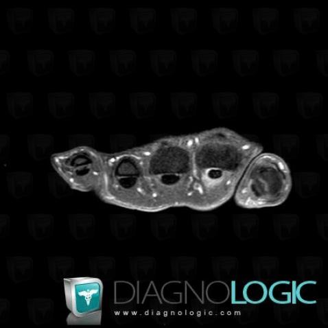 Tendinopathy - Tenosynovitis Wrist - Hand / Flexor digitorum, Tendons/palmar side - Hand, MRI