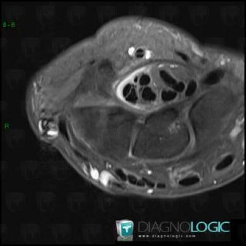 Tendinopathy - Tenosynovitis Wrist - Hand / Flexor digitorum, Tendons/palmar side - Wrist, MRI