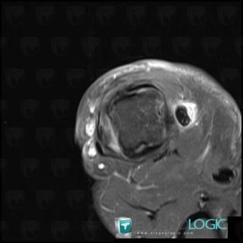 Tendinopathy - Tenosynovitis Wrist - Hand / Long flexor pollicis, Tendons/palmar side - Hand, MRI