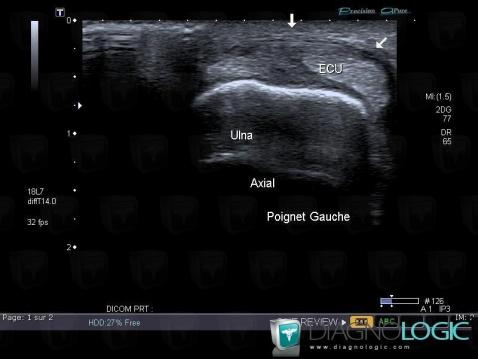 Tendons/face dorsale - Poignet, Echographie