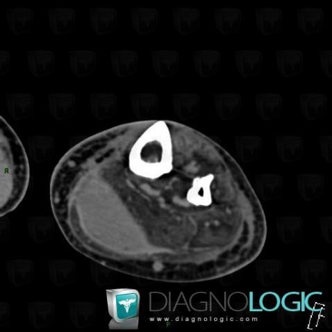 Tennis leg , Muscles - Leg, CT