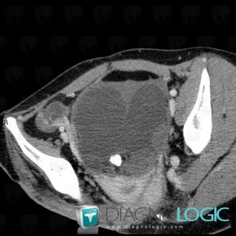 Teratoma, Adnexa / Ovary fallopian tube, CT