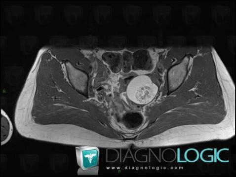 Teratoma, Adnexa / Ovary fallopian tube, MRI