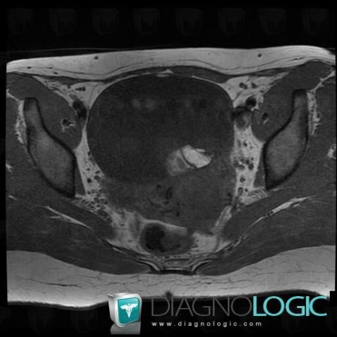 Teratoma, Adnexa / Ovary fallopian tube, MRI