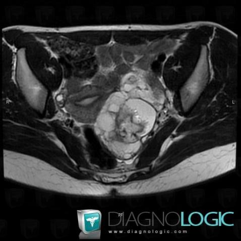 Teratoma, Adnexa / Ovary fallopian tube, MRI