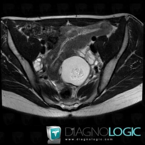 Teratoma, Adnexa / Ovary fallopian tube, MRI