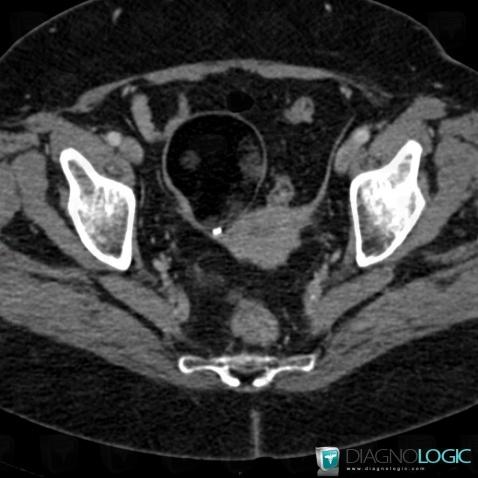 Teratoma, Adnexa / Ovary fallopian tube, Pelvis / Perineum, CT