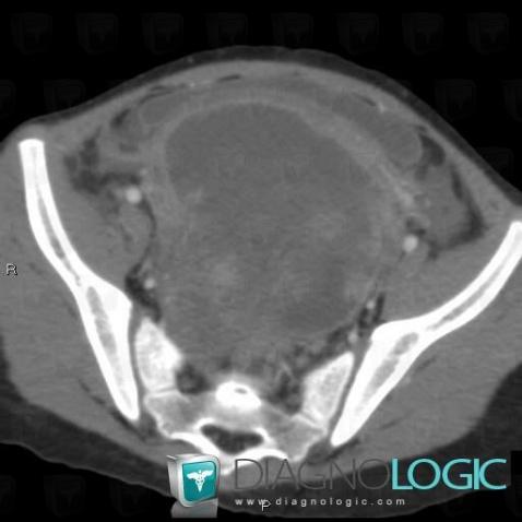 Teratoma, Adnexa / Ovary fallopian tube, Pelvis / Perineum, CT