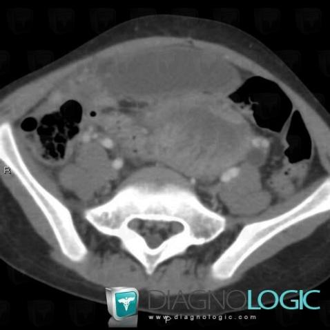 Teratoma, Adnexa / Ovary fallopian tube, Pelvis / Perineum, CT