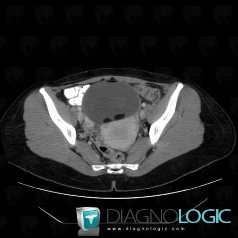 Teratoma, Adnexa / Ovary fallopian tube, Pelvis / Perineum, CT