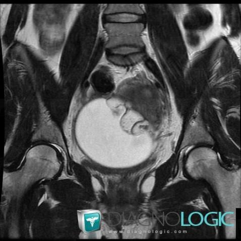 Teratoma, Adnexa / Ovary fallopian tube, Pelvis / Perineum, MRI