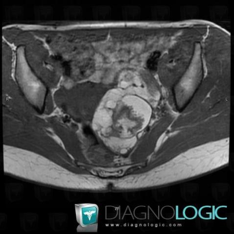 Teratoma, Adnexa / Ovary fallopian tube, Pelvis / Perineum, MRI