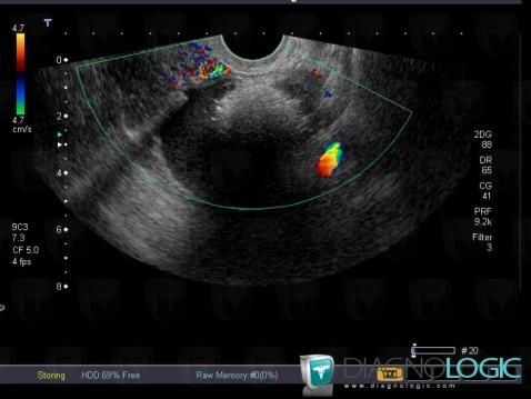 Teratoma, Adnexa / Ovary fallopian tube, Pelvis / Perineum, US