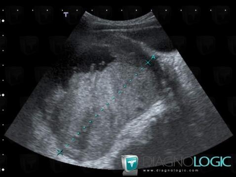 Teratoma, Adnexa / Ovary fallopian tube, Pelvis / Perineum, US