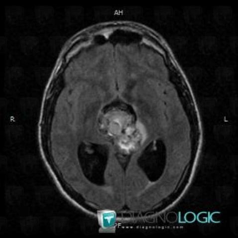 Teratoma, Cerebral hemispheres, MRI