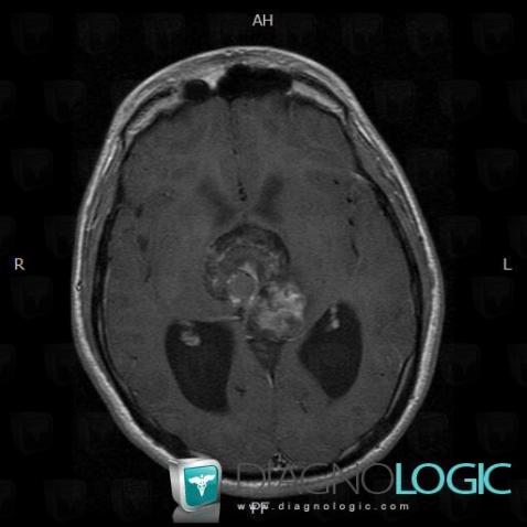 Teratoma, Cerebral hemispheres, MRI