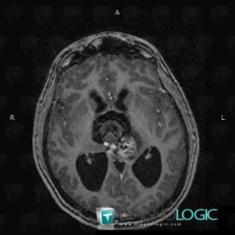 Teratoma, Cerebral hemispheres, MRI