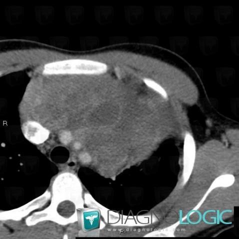 Teratoma, Mediastinum, CT