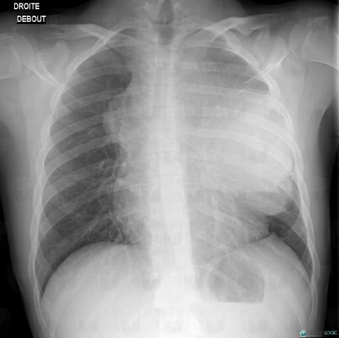 Teratoma, Mediastinum, X rays