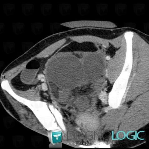 Teratoma, Pelvis / Perineum, CT