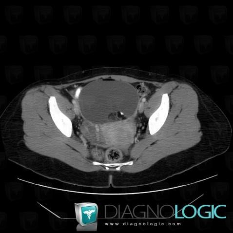 Teratoma, Pelvis / Perineum, CT