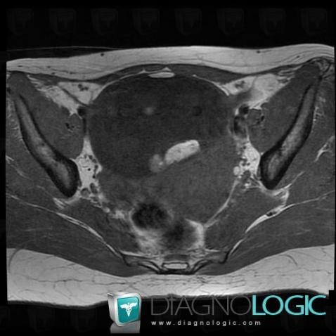 Teratoma, Pelvis / Perineum, MRI