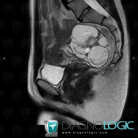 Teratoma, Pelvis / Perineum, MRI