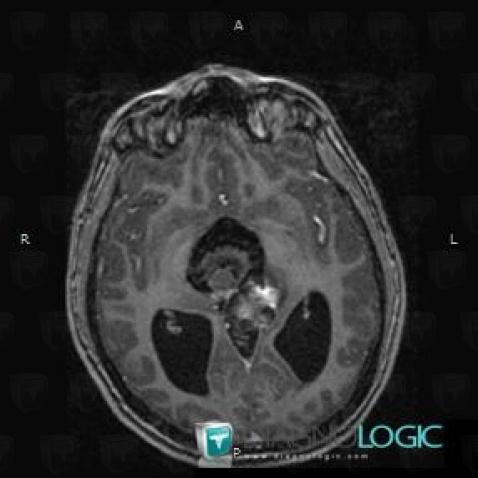 Teratoma, Pineal region, MRI