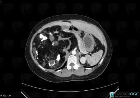 Teratoma, Retroperitoneum, CT