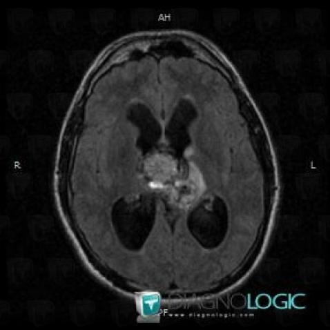 Teratoma, Ventricles / Periventricular region, MRI