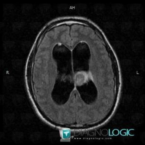 Teratoma, Ventricles / Periventricular region, MRI