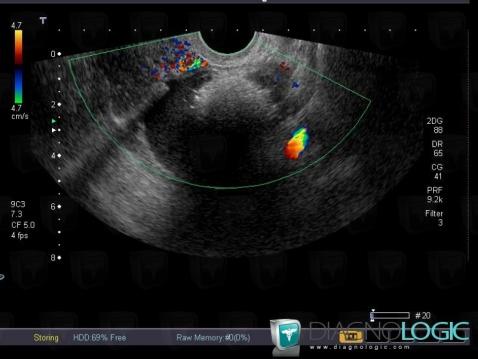 Tératome, Annexe / Ovaire - trompe, Pelvis / Périnée, Echographie
