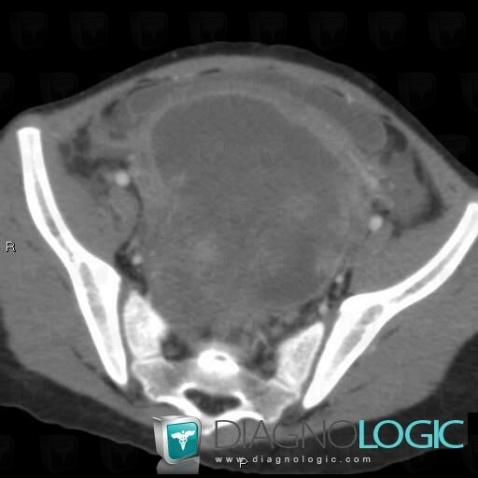 Tératome, Annexe / Ovaire - trompe, Pelvis / Périnée, Scanner