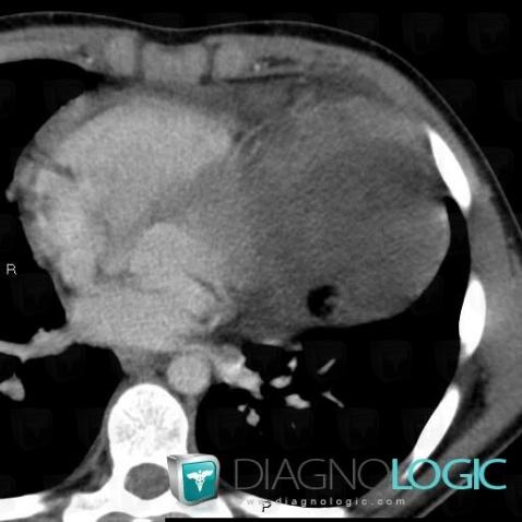 Tératome, Médiastin, Scanner