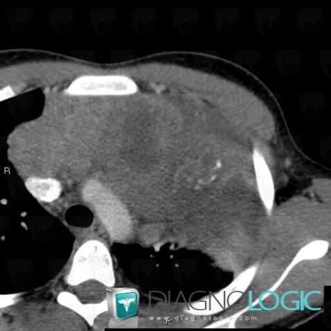 Tératome, Médiastin, Scanner