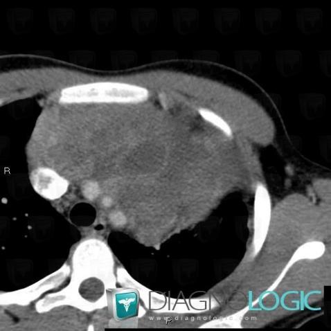 Tératome, Médiastin, Scanner