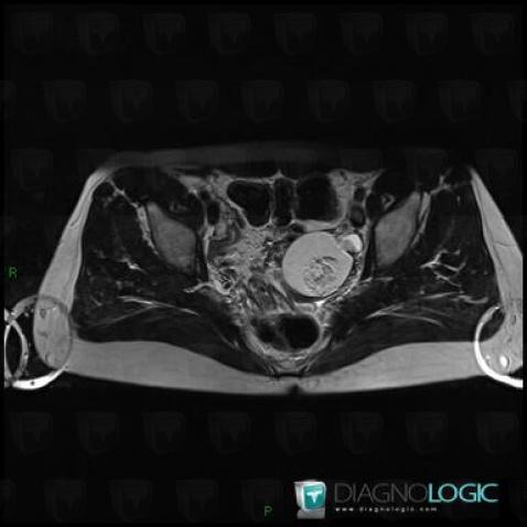 Tératome, Pelvis / Périnée, IRM