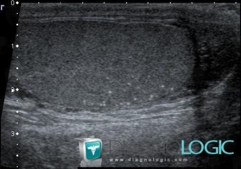 Testicular microlithiasis, Scrotum, US