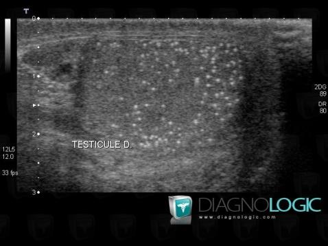 Testicular microlithiasis, Scrotum, US