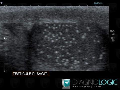 Testicular microlithiasis, Scrotum, US