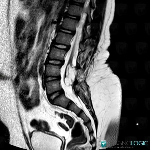 Tethered cord , Spinal canal / Cord, MRI