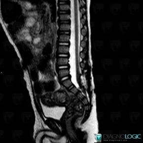 Tethered cord , Spinal canal / Cord, MRI