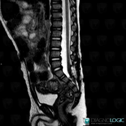 Tethered cord , Spinal canal / Cord, MRI