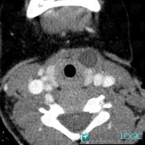 Third branchial cleft cyst, Deep neck spaces, CT