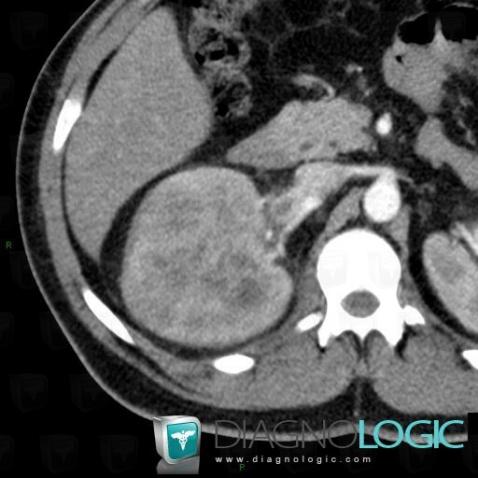 Thrombose de-veine rénale, Autres veines - Abdomen, Scanner