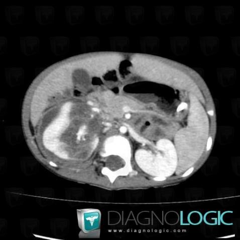 Thrombose de-veine rénale, Autres veines - Abdomen, Scanner