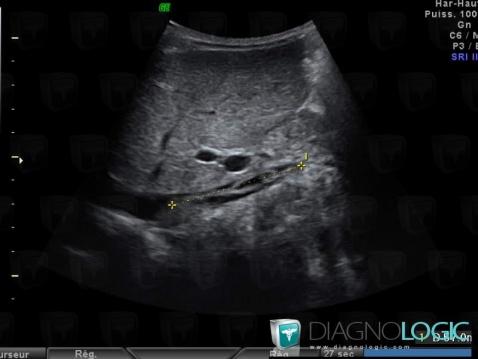 Thrombose veineuse profonde, Veine cave inférieure, Echographie