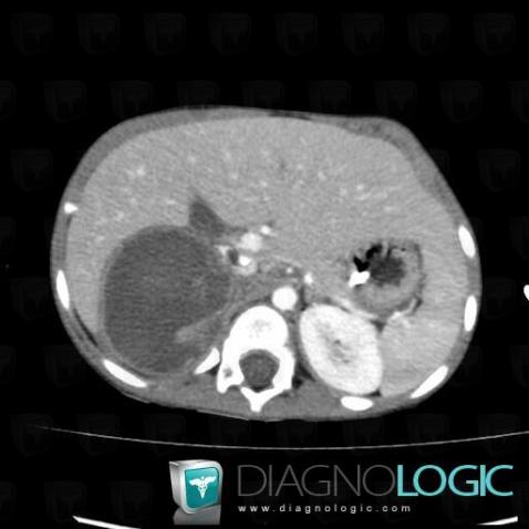 Thrombose veineuse profonde, Veine cave inférieure, Scanner